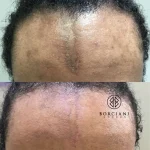Facial scar pigmentation before and after