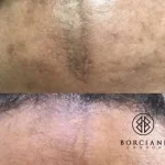 D29DBFCF-0349-4563-9B29-EC4E46C7D2E1-400x284 Scar Reduction
