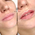 Lip Blush Treatment Before and after