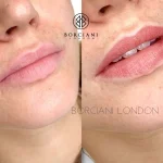 Lip Blush Treatment Before and after