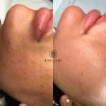 Acne reduction treatment