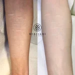 Self harm scar before and after