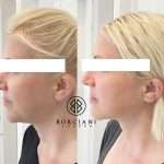 F3973842-1371-462A-8970-2C3C123B25E0_1_105_c Skin tightening