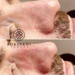 Thread vein removal