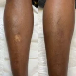 scar camouflage before and after