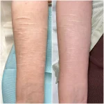 self harm scar before and after