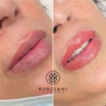 Lip Blush Treatment Before and after