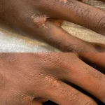 scar camouflage before and after