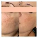IMG_0129-2-400x284 Pigmentation Treatment