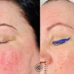 IMG_0249-e1562163900747-400x284 Thread Vein Treatment