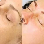 Skin Tightening and pigmentation