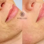 IMG_0253-e1562163421855-400x284 Skin Tightening