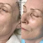 IMG_0421-2-400x284 Skin Tightening
