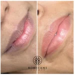 Lip Neutralisation Treatment