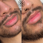 Lip Neutralisation Treatment