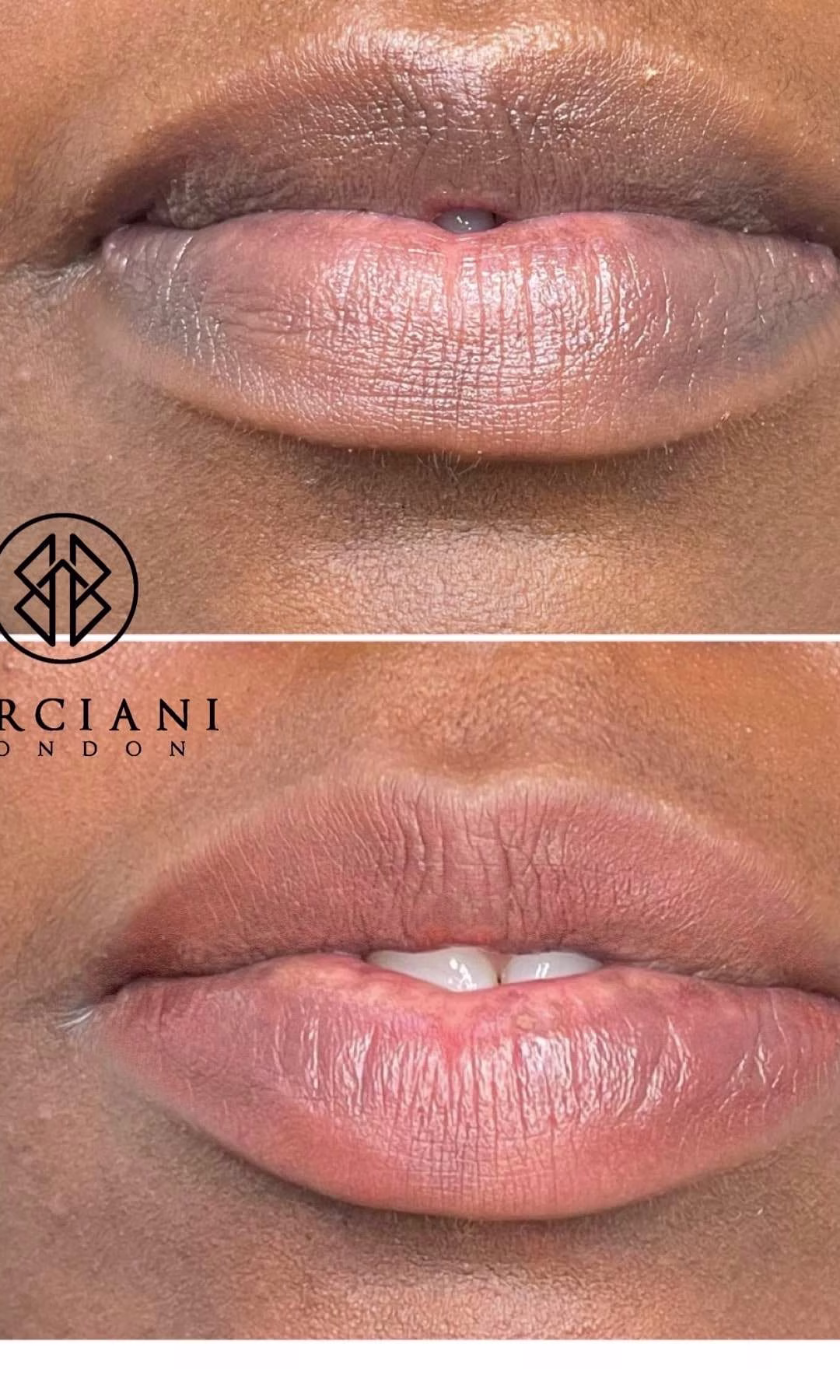 Lip Neutralisation Treatment