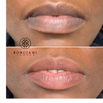 Lip Neutralisation Treatment
