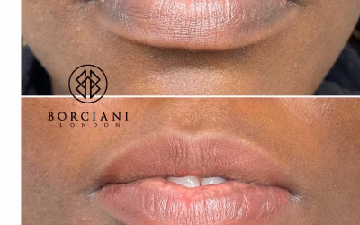Lip Neutralisation Treatment