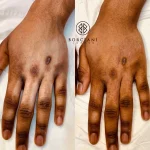scar camouflage before and after