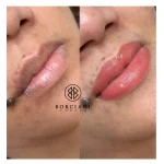 Lip Neutralisation Treatment