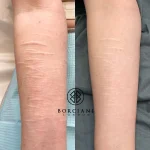 Self harm scar before and after