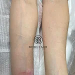 self harm scar before and after CO2 and camouflage