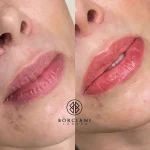 Lip Blush Treatment Before and after