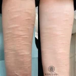 self harm scar before and after