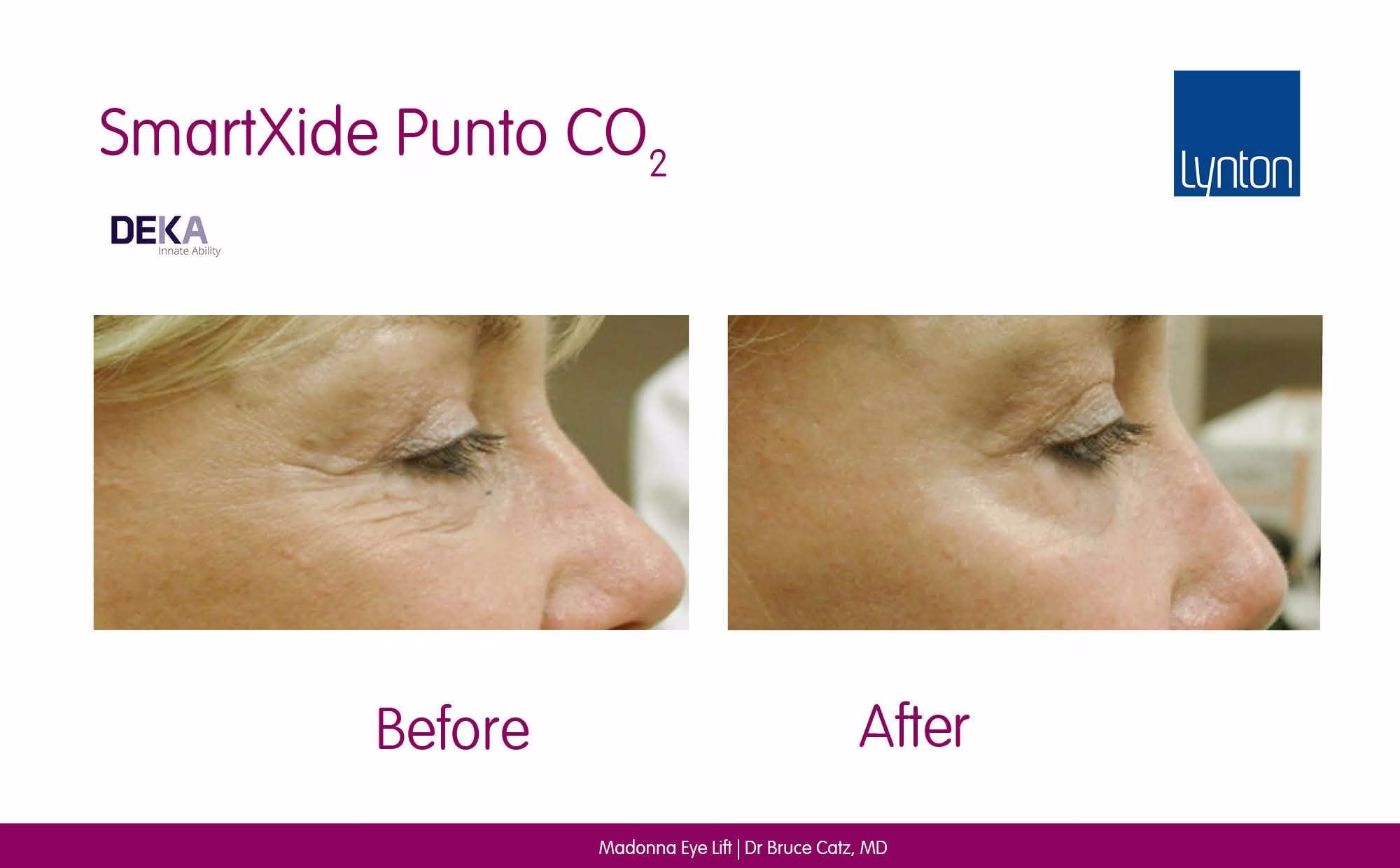 Madonna Eye Lift