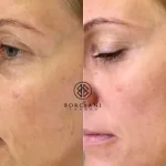 Profhilo-1-400x284 Skin Tightening