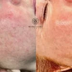 skin rejuvenation gallery skin rejuvenation gallery