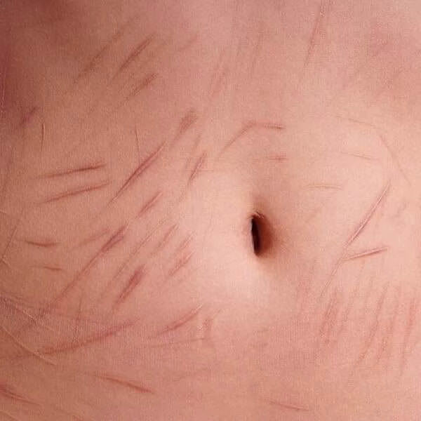 self harm scar treatment London