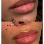 Lip Neutralisation Treatment