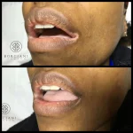 vitiligo before and after