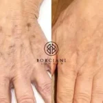 Hand Rejuvenation