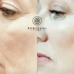 profhilo-400x284 Skin Tightening