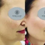 prpfhilo3-400x284 Skin Tightening