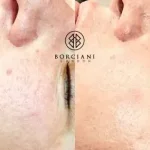 Skin Texture Improvement