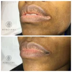 vitiligo before and after