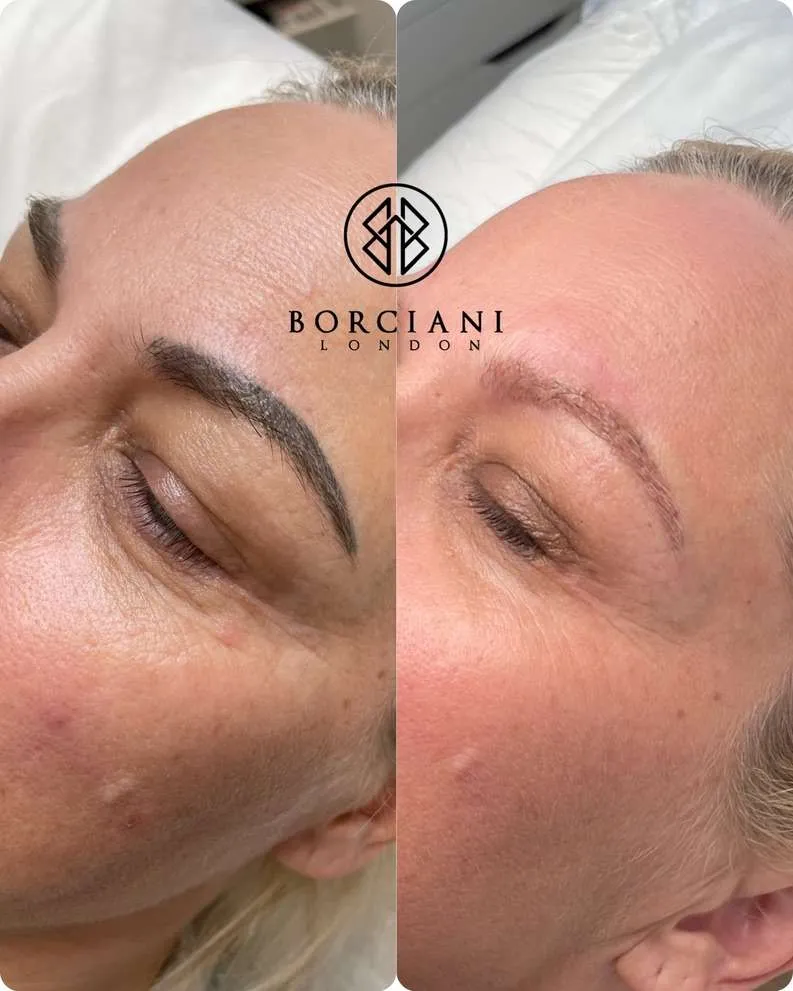 Laser device used for microblading removal