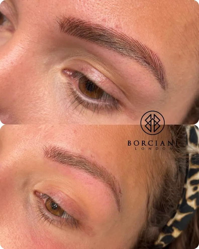 Emergency saline removal on brows