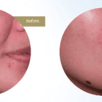 post acne3