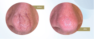 vascular nose
