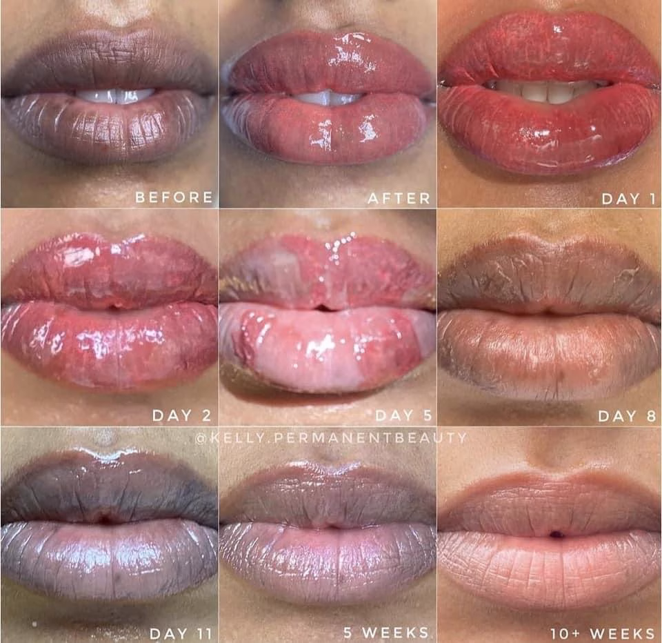 Lip Neutralisation Healing Stages