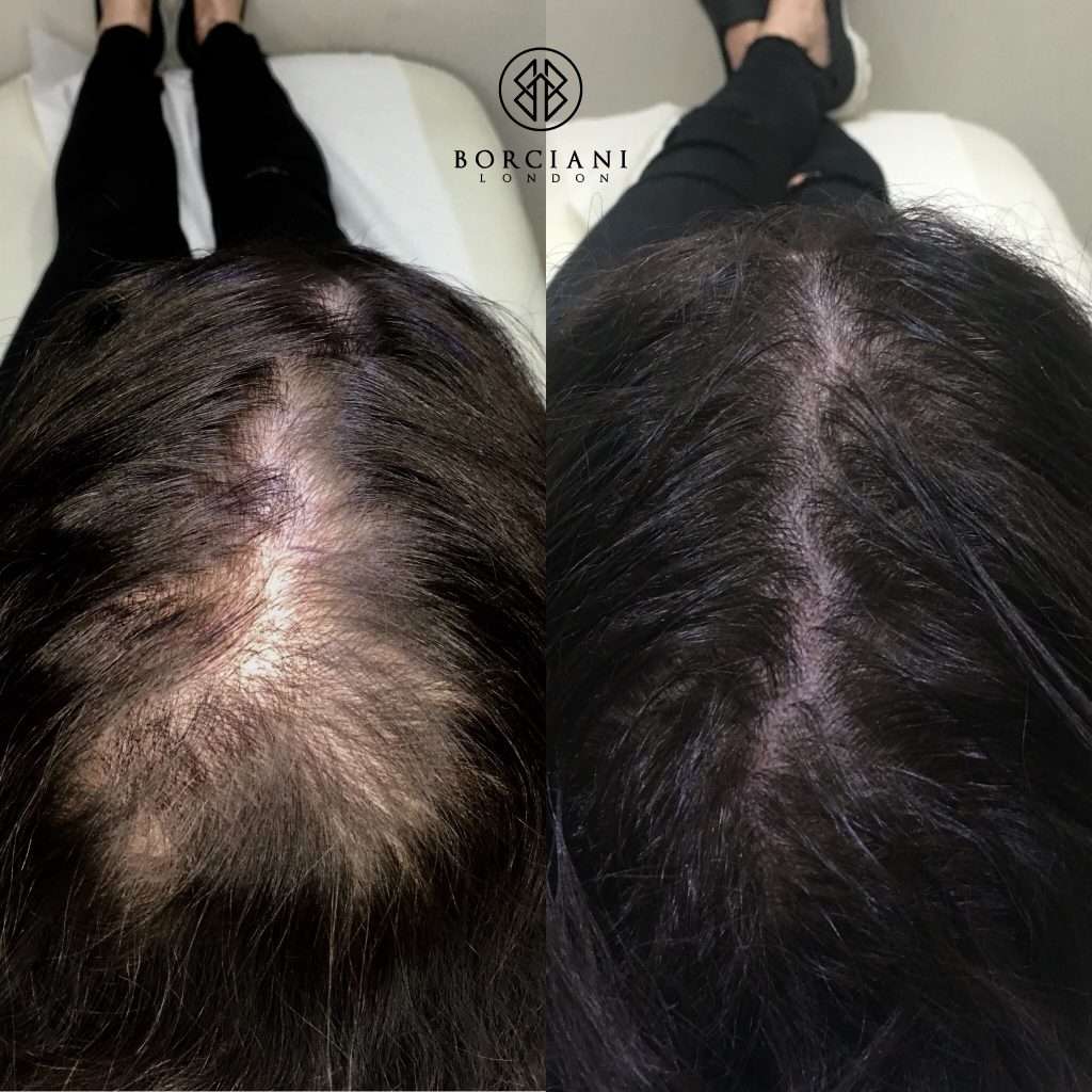 Hair Loss