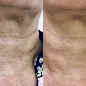 neck rejuvenation