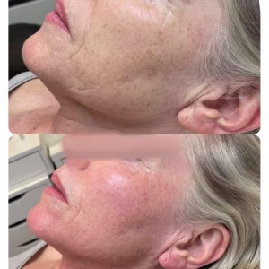 Skin Rejuvenation and tightening