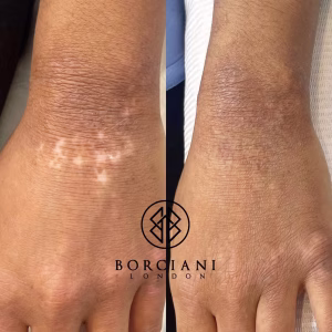 Scar Treatment London