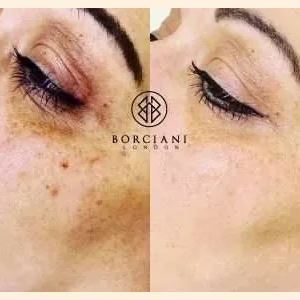 Pigmentation Treatment