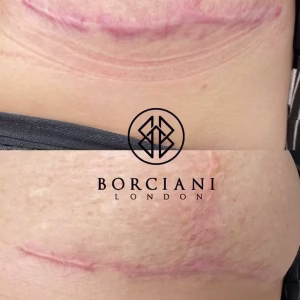 surgical scar reduction before and after